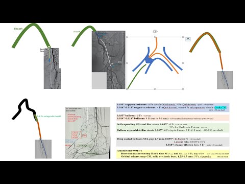 Lower extremity PAD interventions: General approach, techniques, and devices- Elias Hanna