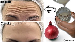 1 onion is a million times stronger than Botox, it eliminates wrinkles and fine lines instantly