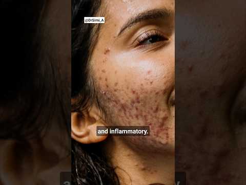 2 Types of Acne | Inflammatory Acne vs Noninflammatory Acne