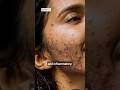 2 Types Of Acne Inflammatory Acne Vs Noninflammatory Acne