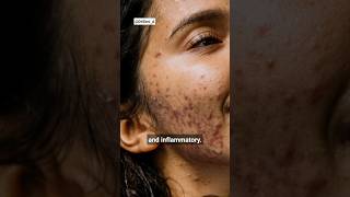 Download lagu 2 Types of Acne | Inflammatory Acne vs Noninflammatory Acne mp3