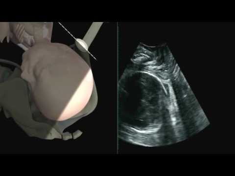 ISUOG: measurement of fetal head--symphysis distance