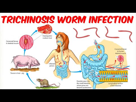 trichinosis cikk az újságban)