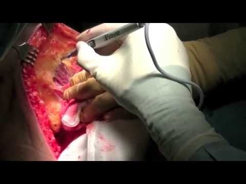 Arthritische Gelenke ersten Grad von Schultergelenk, das ist Einige nehmen Drogen in Osteochondrose des Halses