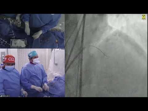 LIVE CASE 7 - PCI of LAD CTO with Antegrade Wiring Technique