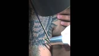 All colour tattoo removal