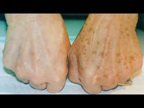 Пигментный крем для удаления пятен Пигментация лицо форум