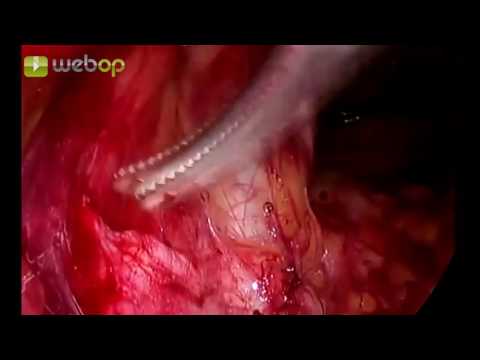 Leistenhernienreparation in TEP-Technik mit DynaMesh ENDOLAP 3D