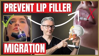 Prevent Lip Filler Migration | Causes, Prevention and How to Treat.