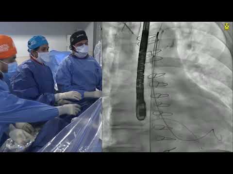 LIVE CASE 2 - TAV-IN-TAV