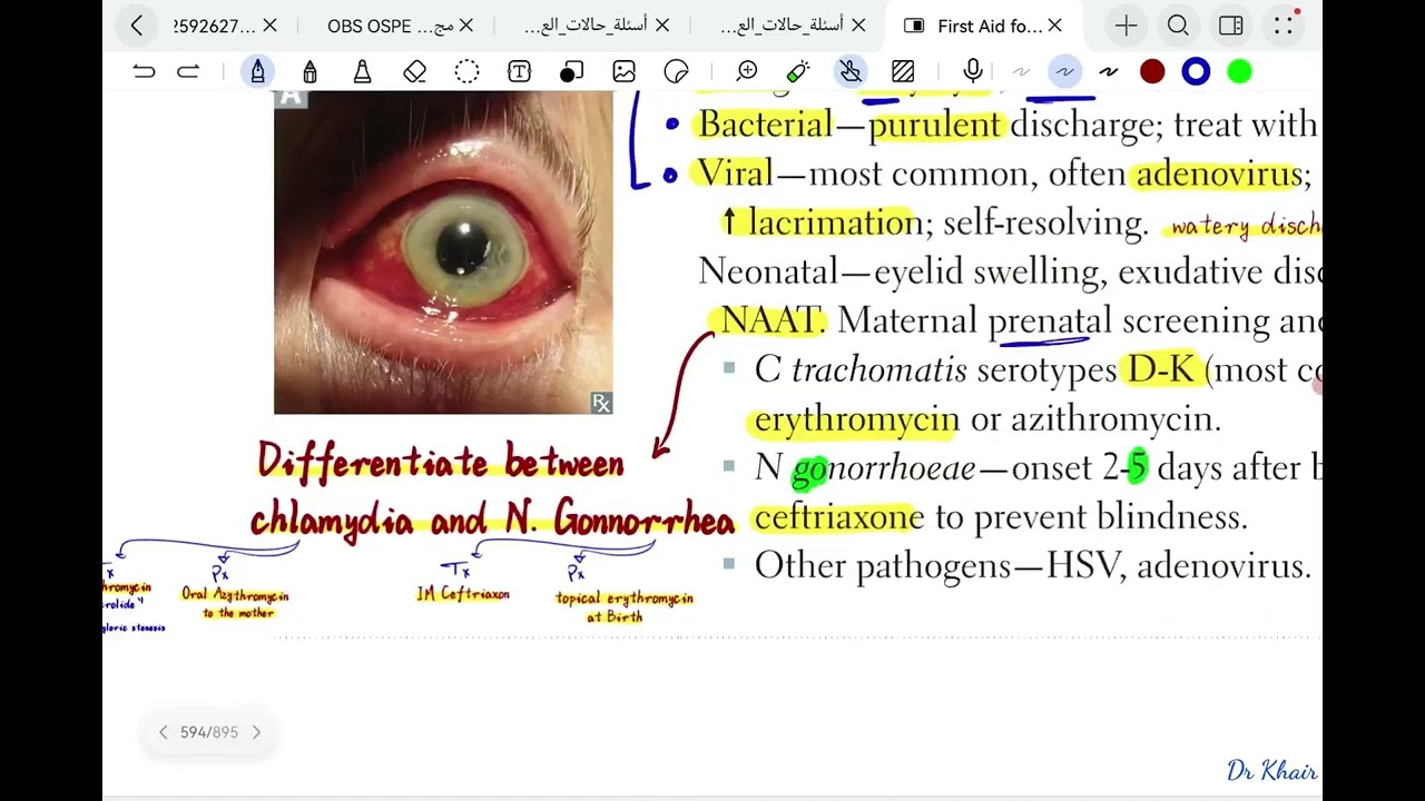 Conjunctivitis 