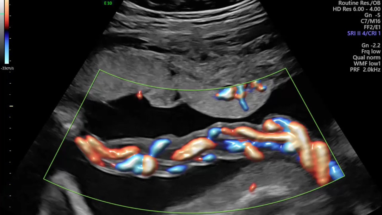 CORDÃO UMBILICAL EM ULTRASSON OBSTETRICO