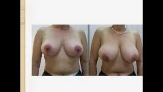 הכל על ניתוח הרמת חזה וניתוח הרמת שדיים - ד"ר אבישי וינברגר מנתח פלסטי