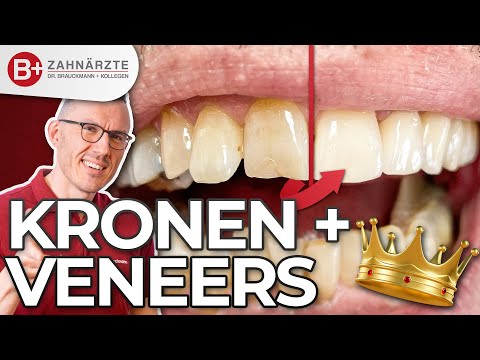 Zahnkronen + Veneers - Kombination zur perfekten Restauration nach Parodontitis!