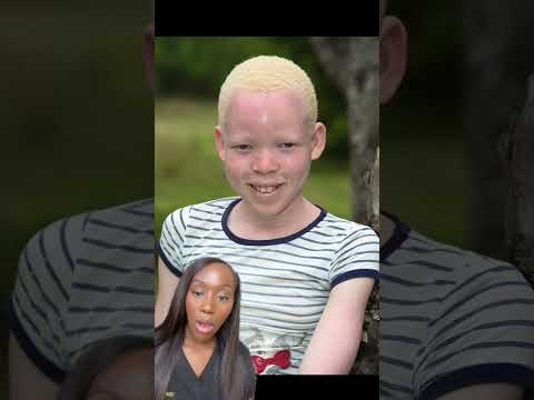 Albinism: Understanding the Genetic Condition and Its Impact