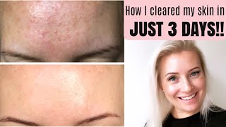 GET RID OF TINY BUMPS ON FOREHEAD FAST | HOW TO TREAT FUNGAL ACNE (MALASSEZIA) | BEING MRS DUDLEY