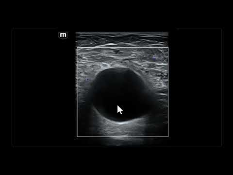Achados ultrassonográficos e diagnósticos diferenciais da linfocele axilar