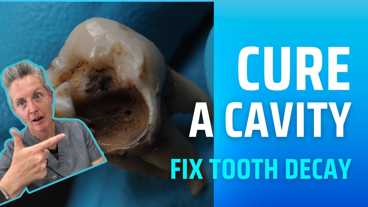 Remineralise Your Teeth: A Guide to Prevent and Reverse Tooth Decay