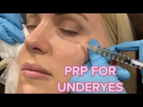 Undereye PRP Injections