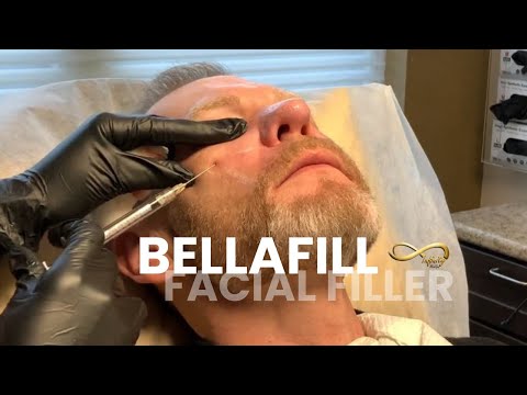 Bellafill Facial Filler | Infinity MedSpa