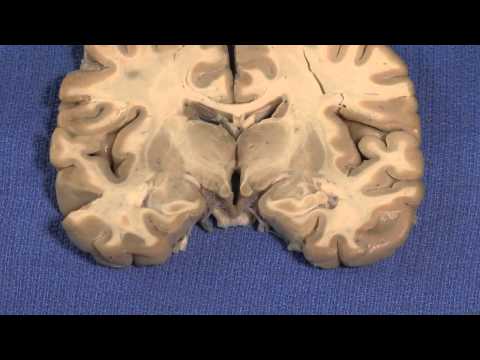 Hypothalamus: Neuroanatomy Video Lab - Brain Dissections