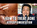 How To Treat ACNE PIGMENTATION PIH