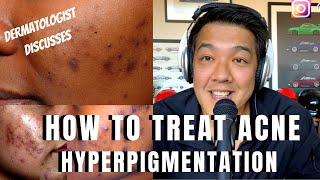 How to treat ACNE PIGMENTATION | PIH
