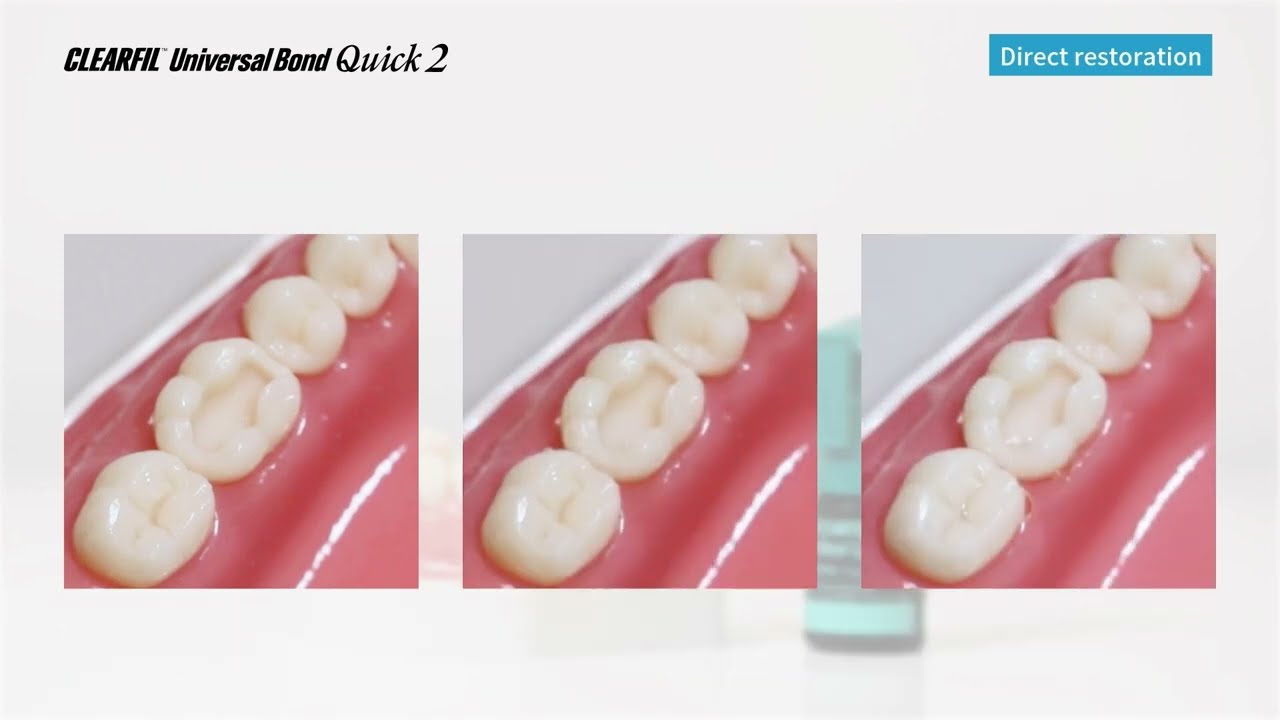2. Direct Restoration with Flowable Composite