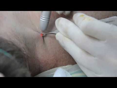 Papiloma genital tratament