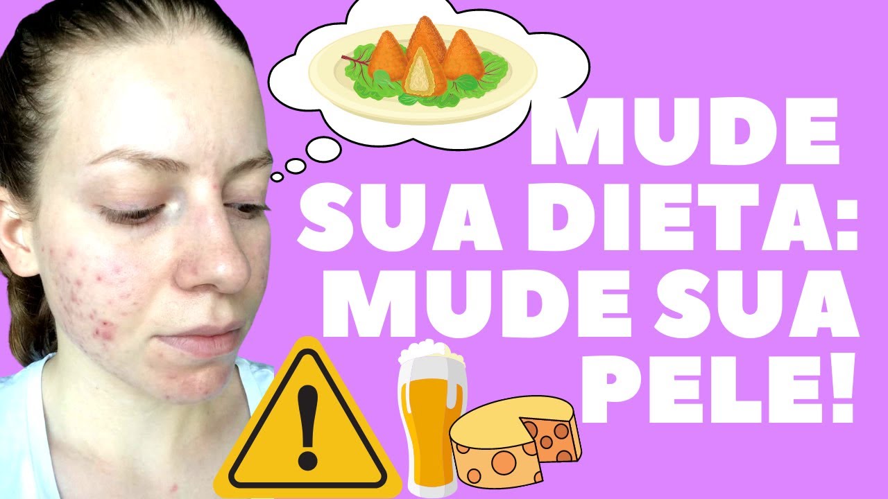 alimentos que PIORAM a ACNE + dicas de como mudar sua dieta!