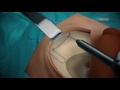 Cochlear Implant Surgery Video Animation