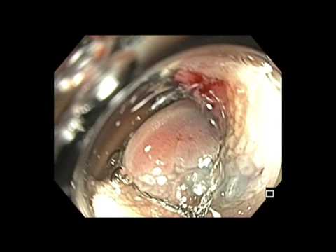 Colonoscopy: LST-NG Tumor Resection