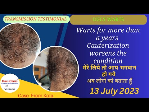 Warts for more than 1 years Getting Cured