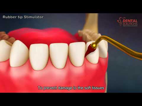 How to use a rubber tip Gum Stimulator work - 3d animation video - Dental Solutions Clinic Bangalore