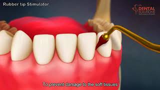 How to use a rubber tip Gum Stimulator work - 3d animation video - Dental Solutions Clinic Bangalore