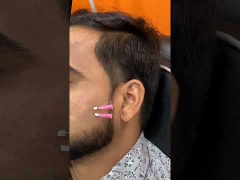 scar treatment (Acne scarring) Thread