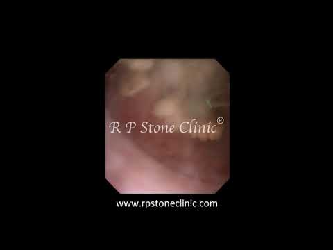 Kidney Stone Lased by Holmium Laser 