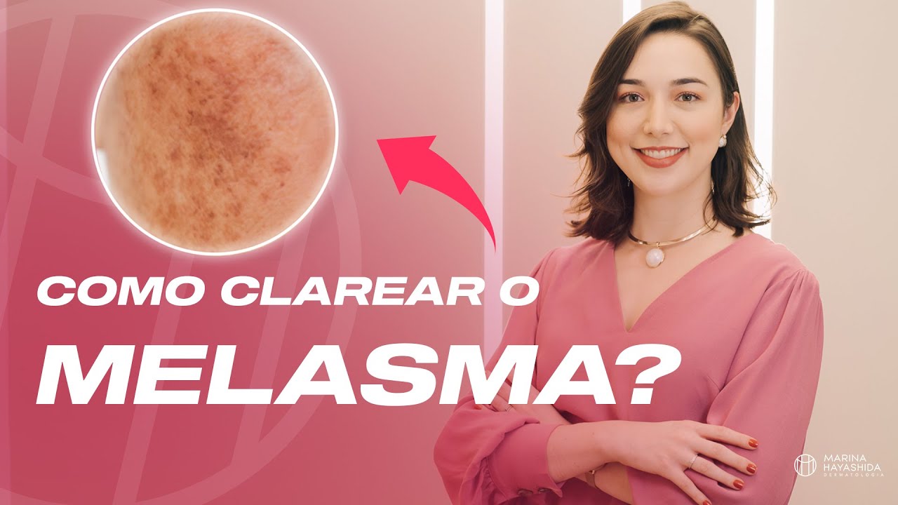 MELASMA NO ROSTO - Descubra COMO CLAREAR AS MANCHAS DE MELASMA