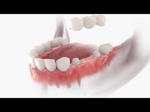 Dental Bridge To Replace Missing Teeth | Tooth Bridge Procedure | Fort Bend Dental