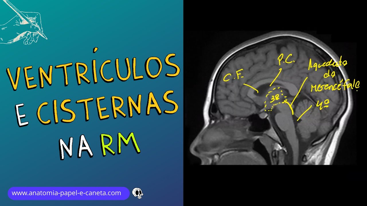 Ventrículos e Cisternas Cerebrais por RM