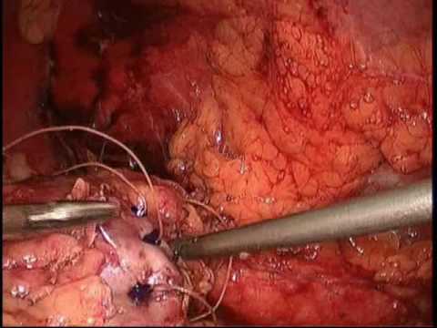  Left Laparoscopic Partial Nephrectomy - Part 3