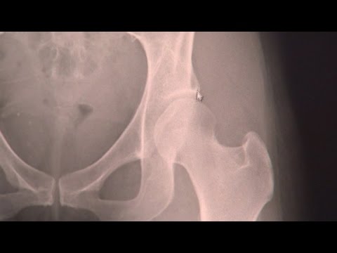 Hip Dysplasia & Surgery