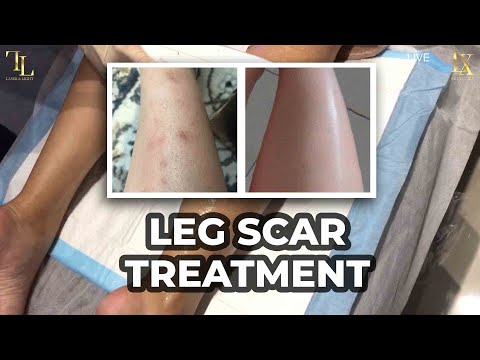 Dark Scars on Leg [Scar Treatment]⚡️