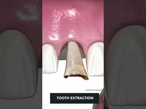Tooth Implant Procedure {STEP BY STEP}