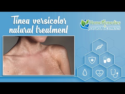 Tinea versicolor natural treatment – coconut oil and aloe vera