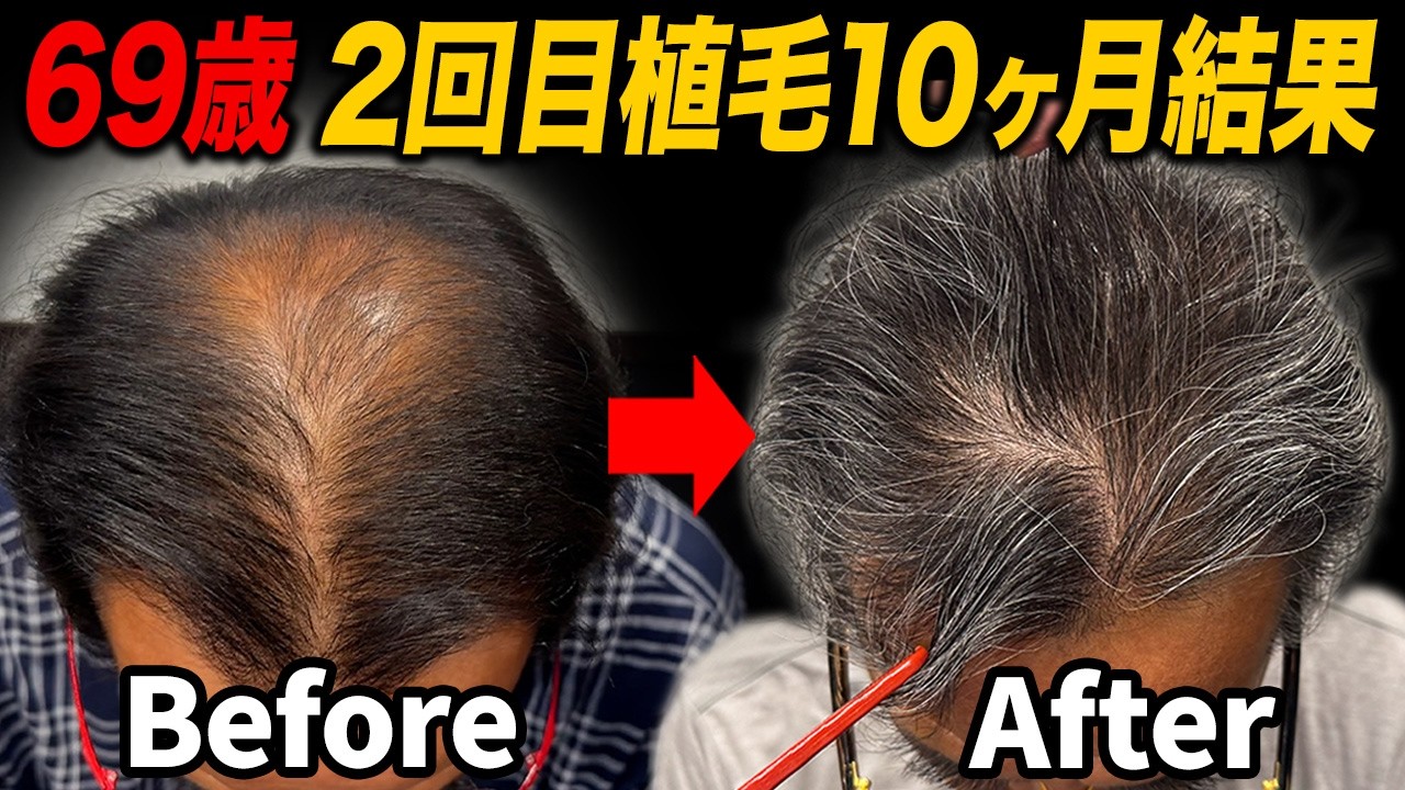 【高齢植毛】69歳で2回目のリスクと10ヶ月の状態