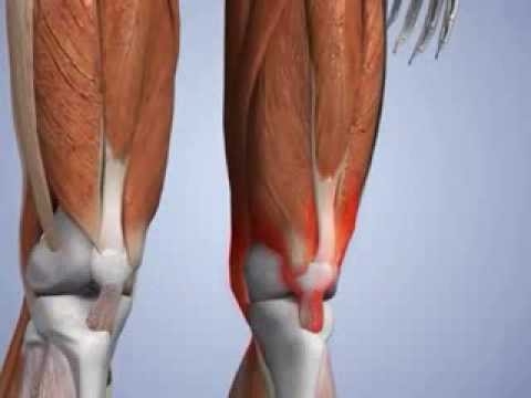 Osteochondrose 2 EL l5-s1 Thorax im Menschen