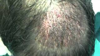 preview picture of video 'Hair Transplant in Multan-Dr.Ahmad (MD)Paris,Associate Professor'