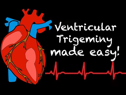 EMS Cardiology || Tachy Tuesday: Ventricular Trigeminy