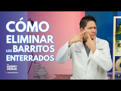 COMO ELIMINAR LOS BARRITOS ENTERRADOS